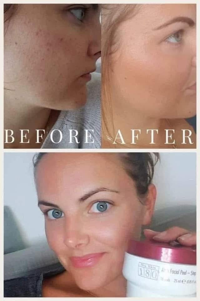 180 AHA Facial Peel and Neutralizer