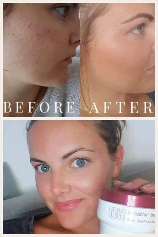 180 AHA Facial Peel and Neutralizer